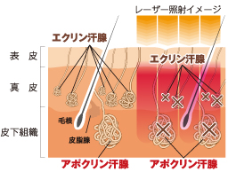 浸透型レーザーの照射図