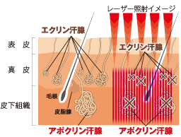 浸透型レーザーの照射図