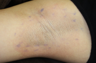 レーザー治療をした直後のワキの様子